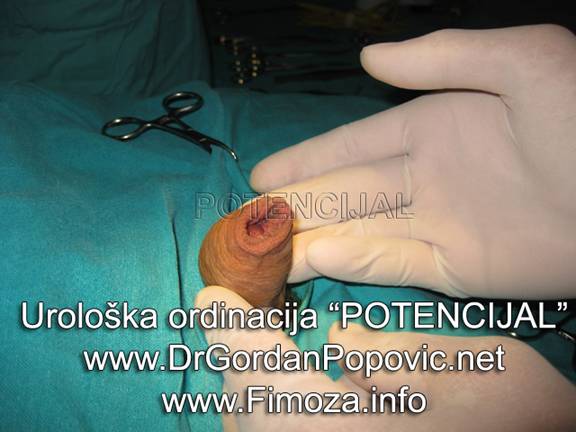 Fimoza operacija