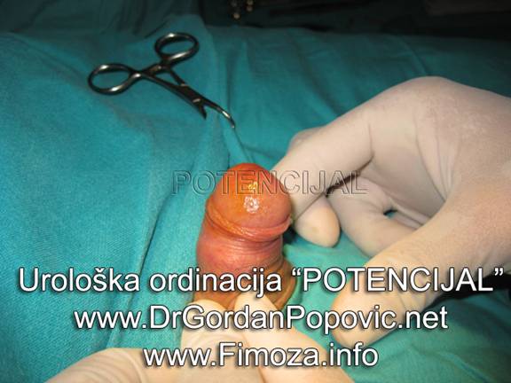 Fimoza operacija