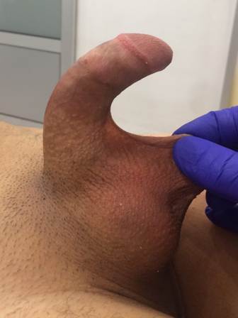 Urodjena iskrivljenost penisa sa kratkom kožom penisa pre operacije