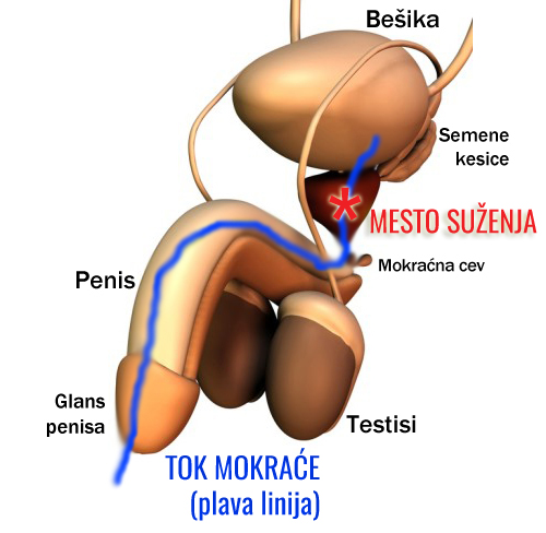 Najčešća oboljenja prostate